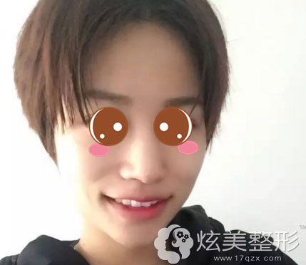 南京康美整形医院冷光美白术后效果图 南京康美整形医院冷光美白术后效果图