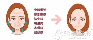 只有适合自己的除皱方法才能有效除皱 只有适合自己的除皱方法才能有效除皱