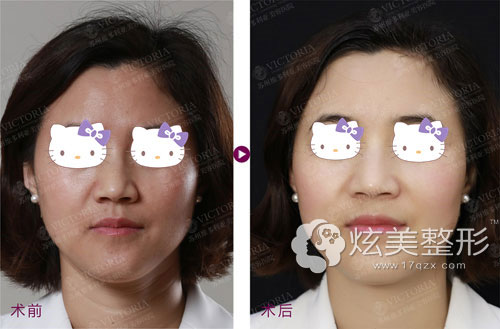 苏州维多利亚嗨体去除颈纹前后对比案例 苏州维多利亚嗨体去除颈纹前后对比案例