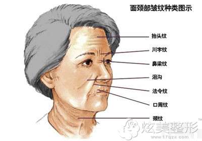 北京张宗学医生告诉你电波拉皮和微创手术拉皮哪个效果好