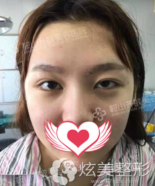 双眼皮整形失败导致大小眼 双眼皮整形失败导致大小眼