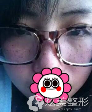 激光祛雀斑真人案例术前图石家庄美莱整形 激光祛雀斑真人案例术前图石家庄美莱整形