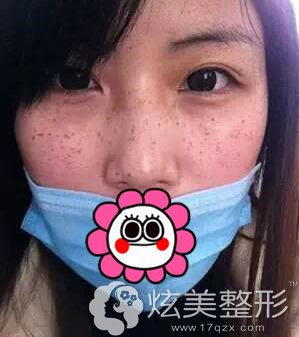 激光祛雀斑案例术后第三天石家庄美莱整形 激光祛雀斑案例术后第三天石家庄美莱整形