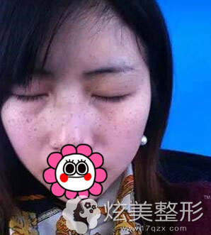 石家庄美莱整形医院激光祛雀斑案例术后7天效果图 石家庄美莱整形医院激光祛雀斑案例术后7天效果图