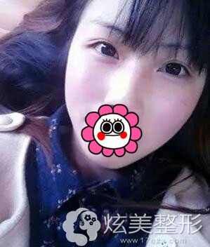 术后第15天激光祛雀斑案例石家庄美莱整形 术后第15天激光祛雀斑案例石家庄美莱整形