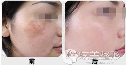 真人案例石家庄美莱整形医院祛雀斑 真人案例石家庄美莱整形医院祛雀斑
