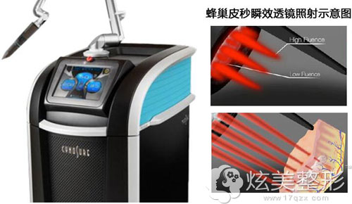 蜂巢皮秒激光祛斑神器 蜂巢皮秒激光祛斑神器