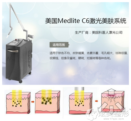 杭州时光采用美国MedliteC6激光美肤系统祛斑原理 杭州时光采用美国MedliteC6激光美肤系统祛斑原理