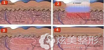 上海玫瑰整形激光祛黑眼圈原理 上海玫瑰整形激光祛黑眼圈原理