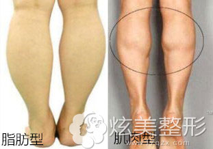 脂肪型腿肌肉型腿区别图 脂肪型腿肌肉型腿区别图