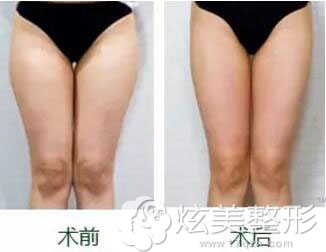 溶脂瘦腿案例效果图西安高一生 溶脂瘦腿案例效果图西安高一生