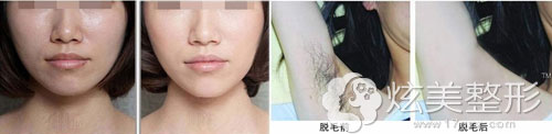脱毛案例找宜春天泽皮肤科周玲 脱毛案例找宜春天泽皮肤科周玲
