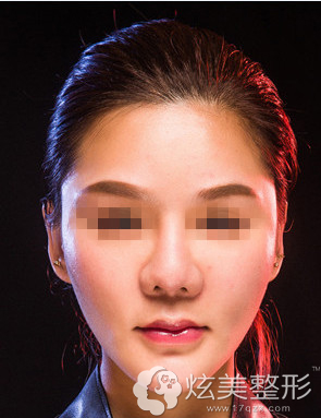 刘运奇医生为琪琪隆鼻术后鼻子自然立体 刘运奇医生为琪琪隆鼻术后鼻子自然立体