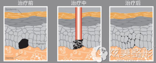 美国C10革新净肤王祛色素斑的治疗原理 美国C10革新净肤王祛色素斑的治疗原理