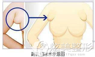 副乳切除手术 副乳切除手术