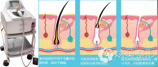 莱茜尔半导体激光脱毛仪及脱毛原理 莱茜尔半导体激光脱毛仪及脱毛原理