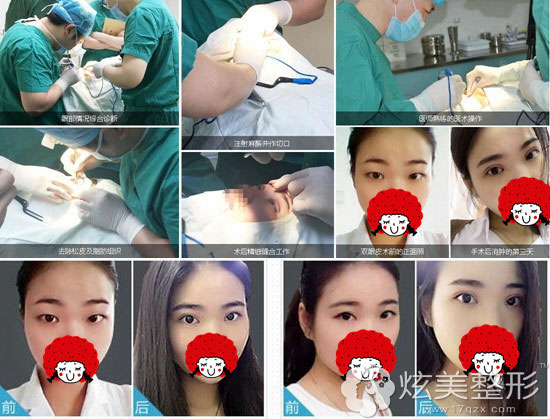 在武汉华美双眼皮整形过程 在武汉华美双眼皮整形过程