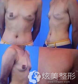 真人案例术前乳头缺陷平胸照 真人案例术前乳头缺陷平胸照