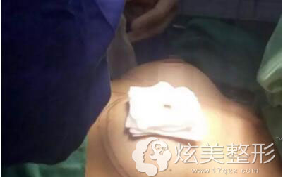 术后多层叠加四川娇点整形隆胸案例 术后多层叠加四川娇点整形隆胸案例