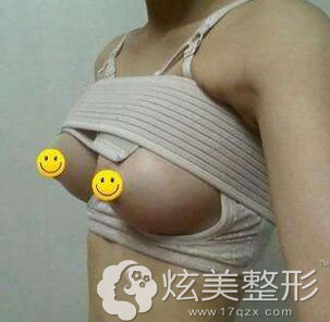 乳头再造+假体隆胸真人案例效果图四川娇点整形 乳头再造+假体隆胸真人案例效果图