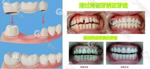 烤瓷牙美白及案例 烤瓷牙美白及案例