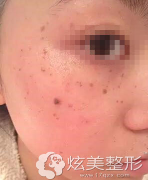 真人案例激光祛斑术前图深圳美莱 真人案例激光祛斑术前图深圳美莱