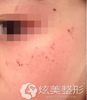 刚做完激光祛斑手术深圳美莱真人案例 刚做完激光祛斑手术深圳美莱