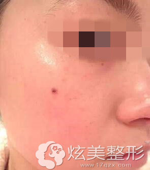 真人案例激光祛斑后结痂7天内掉了深圳美莱整形 真人案例激光祛斑后结痂7天内掉了深圳美莱整形