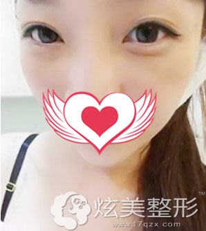 激光祛斑真人案例效果图深圳美莱整形 激光祛斑真人案例效果图深圳美莱整形