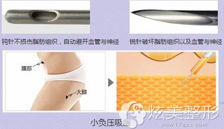钝针及负压抽脂减少脂肪损伤 钝针及负压抽脂减少脂肪损伤