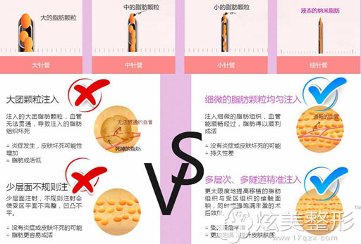 不同脂肪颗粒采用不同针管及上海华美脂肪移植优势 不同脂肪颗粒采用不同针管及上海华美脂肪移植优势
