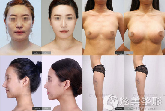 上海华美自体脂肪移植案例 上海华美自体脂肪移植案例