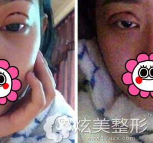 真人案例双眼皮手术第二天北京莫琳娜整形 真人案例双眼皮手术第二天北京莫琳娜整形