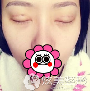 术后一周双眼皮手术真人案例北京莫琳娜整形 术后一周双眼皮手术真人案例北京莫琳娜整形