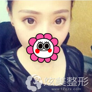 北京莫琳娜真人案例双眼皮手术效果图 北京莫琳娜真人案例双眼皮手术效果图