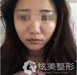 治疗后效果图武汉中爱整形祛痘案例 治疗后效果图武汉中爱整形祛痘案例