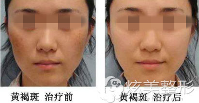 北京玉之光宋丽秋院长超皮秒祛斑真实案例效果图 北京玉之光宋丽秋院长超皮秒祛斑真实案例效果图