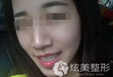 冷光美白真实案例效果图深圳丽港丽格 冷光美白真实案例效果图深圳丽港丽格