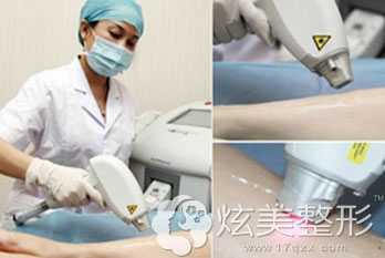 激光脱毛过程图运城丽都 激光脱毛过程图运城丽都