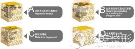 激光祛斑原理示意图 激光祛斑原理示意图