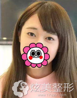 术前眼睛小单眼皮很烦恼真实案例 术前眼睛小单眼皮很烦恼真实案例