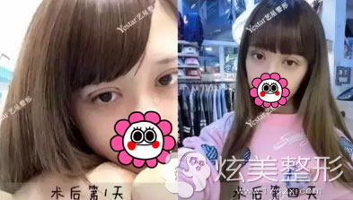 术后第1天、第4天效果图双眼皮真实案例 术后第1天、第4天效果图双眼皮真实案例