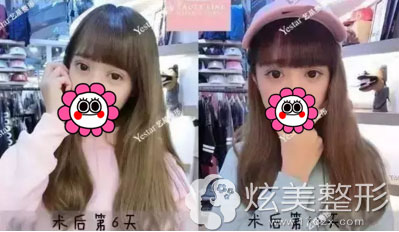 术后第6天、第10天双眼皮真实案例效果图 术后第6天、第10天双眼皮真实案例效果图