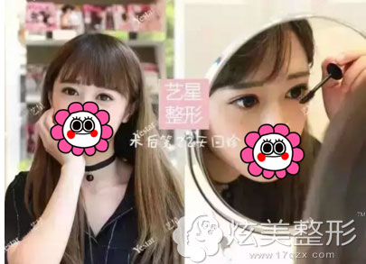 术后22天回诊双眼皮真实案例武汉艺星 术后22天回诊双眼皮真实案例武汉艺星