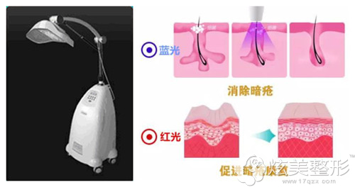 LED红蓝光痤疮治疗仪祛痘原理 LED红蓝光痤疮治疗仪祛痘原理