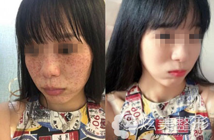 天津美莱整形祛斑案例前后对比照 天津美莱整形祛斑案例前后对比照