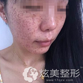 刚做完祛斑天津美莱真实案例 刚做完祛斑天津美莱真实案例