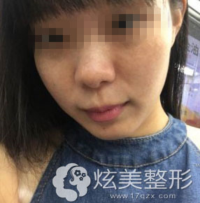 术后10天效果图天津美莱祛斑案例 术后10天效果图天津美莱祛斑案例