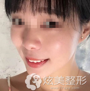 术后效果肌肤白嫩天津美莱整形祛斑 术后效果肌肤白嫩天津美莱整形祛斑