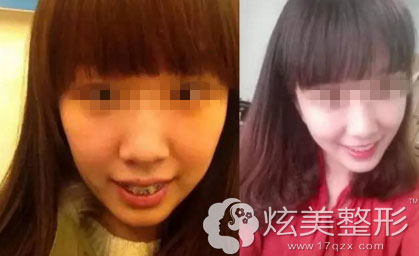 牙齿矫正真实案例对比图合肥佳德口腔 牙齿矫正真实案例对比图合肥佳德口腔